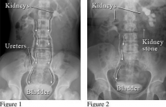 X-ray recording of the renal pelvis and urinary tract after contrast medium is injected into a vein