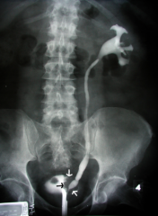 X-ray recording of the renal pelvis and urinary tract after dye is injected through a catheter into the urethra, bladder, and ureters; warranted when the patient is allergic to the dye or if the patient has poor renal function making it impossibl...
