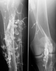 X-ray recording of veins after contrast medium has been given intravenously