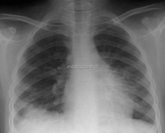 X-ray beam is directed front to back; patient may be in a supine or standing position, having the back near the film and the front facing x-ray tube