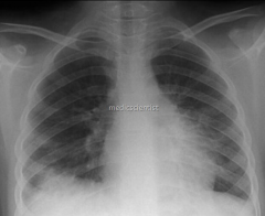 X-ray beam is directed from back to front; patient is usually in an upright position, having the back facing the x-ray tube and the front near the film