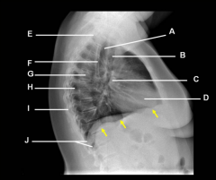 X-ray beam is directed from one side:    
- Right lateral (RL) view, the right side of the body is near the film and the x-ray tube is pointed toward the left side    
- Left lateral (LL) view, the left side of the body is nearest th...
