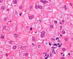 Hepatitis B: causes hepatocellular cytoplasm to fill with HBsAg, fine granular, dull eosinophilic, "ground glass" appearance