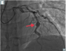 -coronary artery involvement common >> risk of thrombosis with MI and aneurysm with rupture


-so could present with a child with an MI!