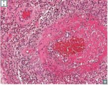 -small vessel vasculitis


-necrotizing granulomatous inflammation with eosinophils involving multiple organs, especially lungs and heart