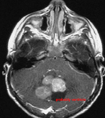 Medulloblastoma 

Treat with surgical resection followed by radiation