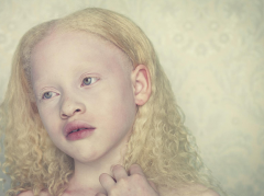 Albinism