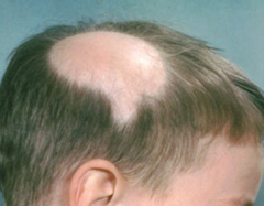 Alopecia (Baldness)