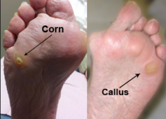 Corns and Calluses