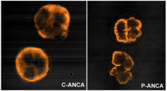 Cytoplasmic ANCA
Perinuclear ANCA
The difference can be visualised on microscope.