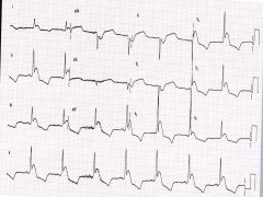 Pronounced positive deflection on QRS complex due to hypothermia