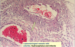 Leptomeningeal vessels with arteritis