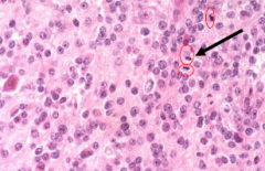 Astrocytoma: Increased cellularity, distinct nuclear atypia, marked mitotic activity