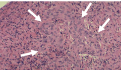 Astrocytoma: Pleomorphic astrocytic cells, brisk mitotic activity, PROMINENT microvascular proliferation and necrosis
