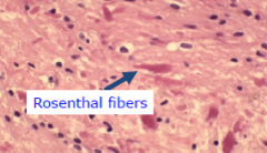 Hair like (elongated fibrillary cells); Rosenthal fibers