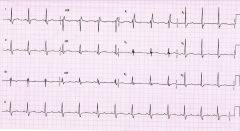 Look for slurred S wave in leads I and V6 


RSR' pattern in lead VI