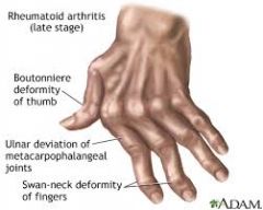 Rheumatoid arthritis is a systematic (i.e. methodical) and progressive condition.


 


Rheumatoid arthritis effects many joints, especially the HANDS.