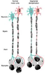 Myelin sheath breaks down around axon