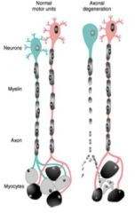 Actual damage to axon - degenerated axons are able to grow back if guided by schwann cells