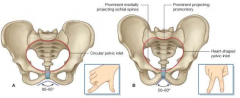 male: heavier build, deeper interior and conical in shape, heart shaped inlet, subpubic angle of 50-60 degrees, sharper coccyx and ischial spines
female: interior is cylindrical, circular inlet, subpubic angle of 80-85 degrees