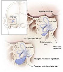 - AR 
- Congenital, early onset 
- The most frequent cause of bilateral sensorineural hearing loss in scholar age
- Thyroid dysfunction -> Goiter 
- Enlarged vestibular aqueduct