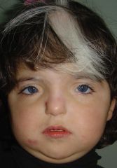 - AD 
- Congenital, early onset 
- White forelock 
- Heterochromia iridum  
- Telecanthus (dystopia canthorum) 

This syndrome is not of easy diagnosis because heterochromia iridis is usually not considered as a sign of a pathology, white for...