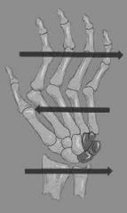 Ulnar deviation or ulnar drift and subluxation of wrists and MCP joints.