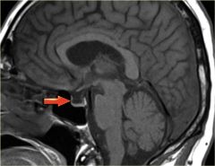 What is empty sella syndrome?  How does it present? 

arrow shows an empty sella