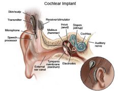 Subcutaneously implanted device that can transform sound waves into electrical impulses that directly stimulate the cochlear nerve with intracochlear electrodes. 

To perform the cochlear implant surgery first of all we perform an retro-auricular...