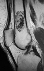 dx-enchondroma
ddx-CSA. bone infact
Malignant transformation ollier's 
