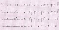 What is the diagnosis of this EKG?