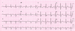What is the diagnosis of this EKG? 