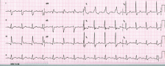 What is the diagnosis of this EKG? 