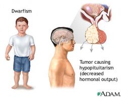 most common from a pituitary adenoma --> central obesity, hyperlipidemia, increase waist-hip ratio, decrease lean body mass; in children it causes dwarfism