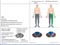 Transverse cord: loss of everything below level of lesion


 


Hemicord: pain and temp loss contralateral and vibration, proprioception and motor loss ipsilaterally. 