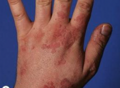 1.  Flat topped pink-brown papules


2.  Grouped on elbows, hands, wrists, and knees