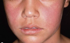 1.  Bright red macular erythema over cheeks


2.  Lacy eruption on extremities