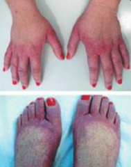1.  Erythema, edema, petechia, and purpura on palms/soles with buying pain and pruritus