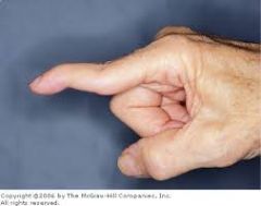 Swan Neck Deformity is hyper-extention of the PIP, flexion of the DIP.