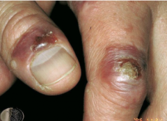 1.  Parapox virus


2.  Solitary red-purple nodule on finger
