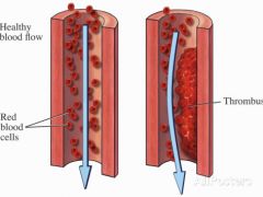 b. thrombus 


Atherosclerosis refers to the build up of fatty deposits called plaques in the walls of the arteries.

Over time these deposits of cholesterol, fat and the smooth muscle cells that line the arteries are transformed into a thick...