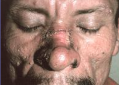 1.  Slowly-spreading papule or papulopustules on exposed skin
2.  Miliary abscesses
3.  Lung disease