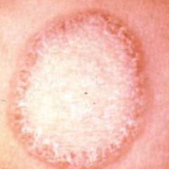 1.  Erythematous macule becomes papular, annular or confluent plaque with central clearing
2.  In almost any body region