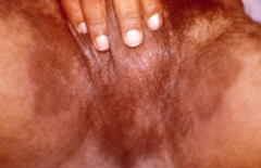 1.  Brown well-defined patches
2.  Found in groin, axillae, toe webs, or breast folds