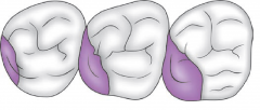 • From the developmental point of view, the maxillary
molars have only three primary cusps namely, the
mesiobuccal, the distobuccal and the mesiolingual 

•The distolingual cusp becomes progressively smaller on
2nd and 3rd maxillary molar...