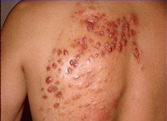 1.  Variety of lesions--- cellulitis, pustules, abscesses