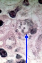 1.  Amastigotes in macrophage
