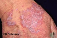 1.  Flat-topped erythematous or violaceous puristic papules
2.  Reticulate white lines