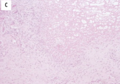 1.  Histiocytes surrounding eosinophilic fibrin
