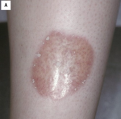 1.  Pretibial surface
2.  Well-demarcated red brown papules
